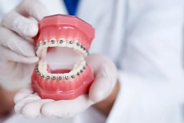 Four Ways Dental Braces Can Benefit Your Oral Health